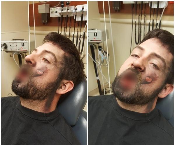 Hình ảnh thanh niên sau khi bị thuốc lá điện tử nổ trong miệng
